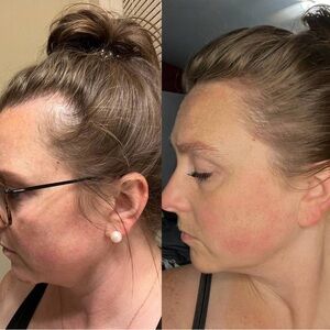 NEED THINNING HAIR HELP?